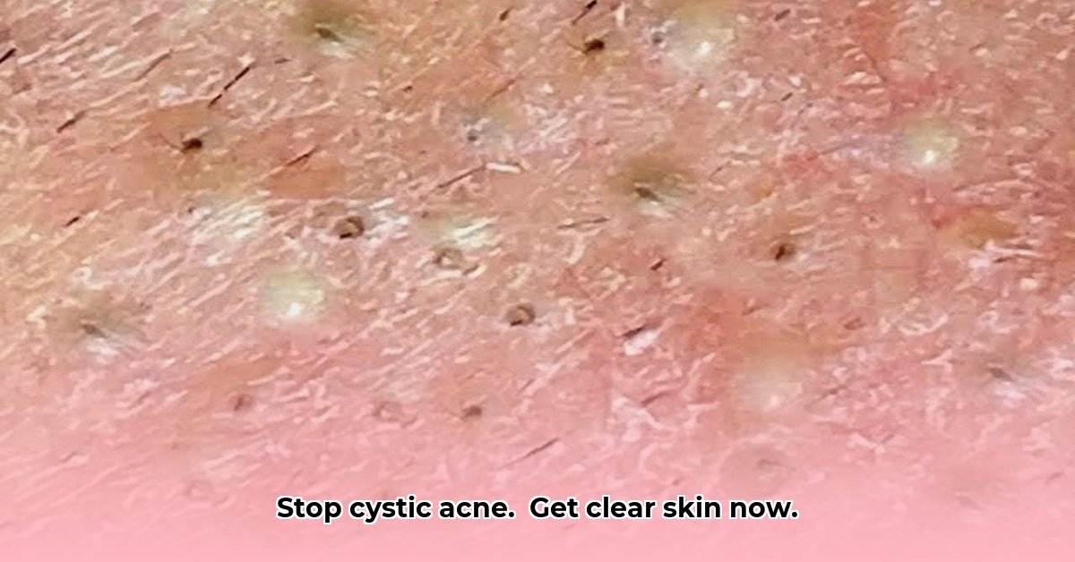cystic-acne-popping